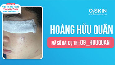 Tôi Đã Trị Mụn Thành Công Như Thế Nào? - Mã Số 09