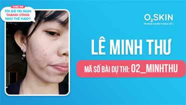 Tôi Đã Trị Mụn Thành Công Như Thế Nào? - Mã Số 02