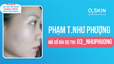 Tôi Đã Trị Mụn Thành Công Như Thế Nào? - Mã Số 03