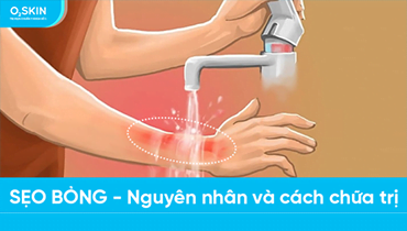 Sẹo Bỏng - Nguyên Nhân Và Cách Chữa Trị