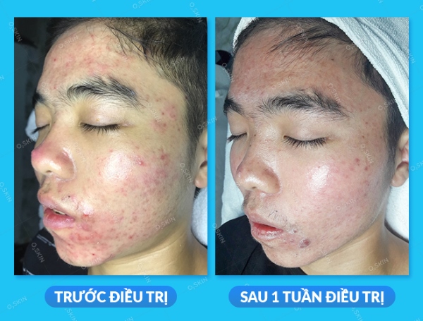 Mụn giảm sau 1 tuần điều trị phác đồ điều trị mụn tại O2 SKIN