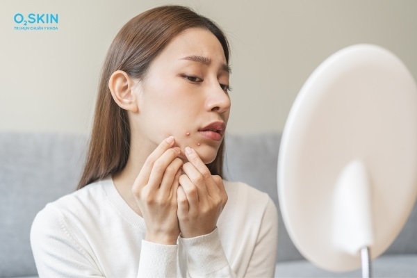 Mụn Mủ: Dấu Hiệu, Nguyên Nhân, Cách Trị Và Phòng Ngừa