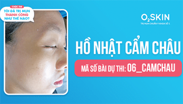 Tôi Đã Trị Mụn Thành Công Như Thế Nào? - Mã Số 06