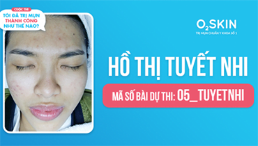 Tôi Đã Trị Mụn Thành Công Như Thế Nào? - Mã Số 05