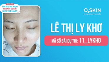 Tôi Đã Trị Mụn Thành Công Như Thế Nào? - Mã Số 11