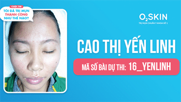 Tôi Đã Trị Mụn Thành Công Như Thế Nào? - Mã Số 16