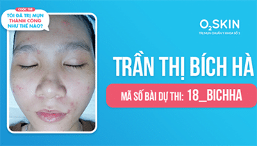 Tôi Đã Trị Mụn Thành Công Như Thế Nào? - Mã Số 18