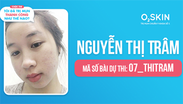 Tôi Đã Trị Mụn Thành Công Như Thế Nào? - Mã Số 07