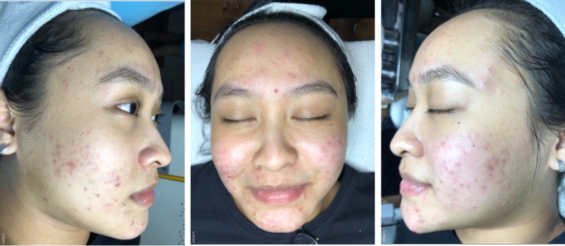 Hình ảnh da Phương trong đầu đến Phòng khám O2 SKIN