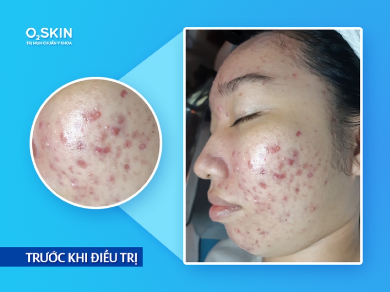 Làn da nhiều mụn của Cát Tường trước khi điều trị tại O2 SKIN