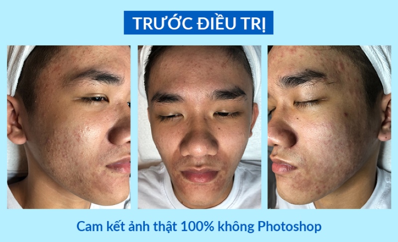 Tình trạng mụn ẩn của Nam trước khi điều trị tại O2 SKIN