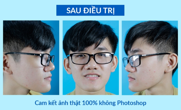 Công Nam sau một tháng kiên trì điều trị mụn tại O2 SKIN