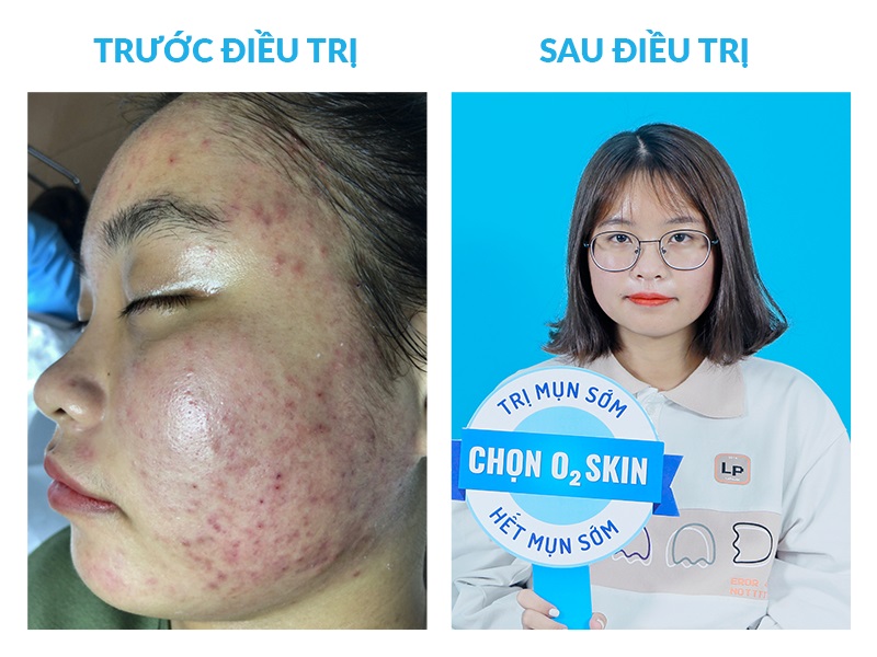 Minh Thư trước và sau khi điều trị mụn tại O2 SKIN