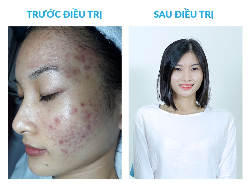 Huệ trước và sau khi điều trị mụn tại O2 SKIN