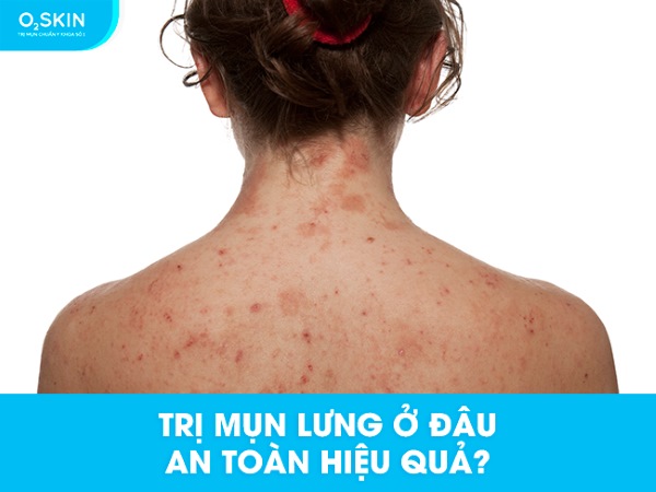 Trị mụn lưng ở đâu an toàn hiệu quả?