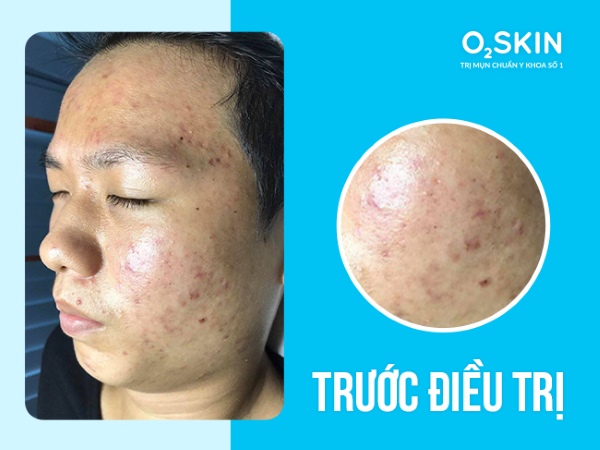 Trước điều trị.