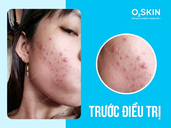 Tình trạng da mụn viêm trước khi điều trị tại O2 SKIN