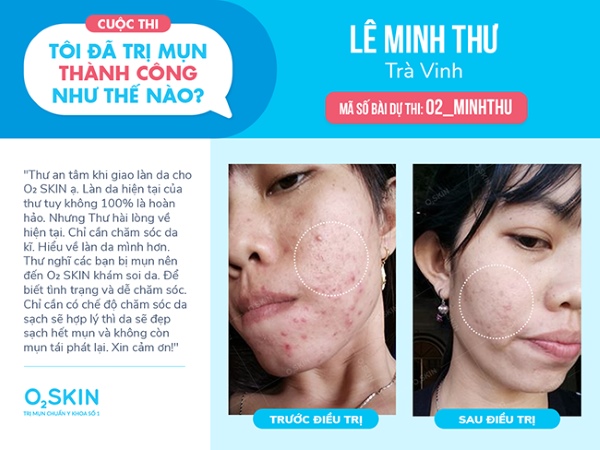 TÌnh trạng da có sự cải thiện sau mỗi lần tái khám