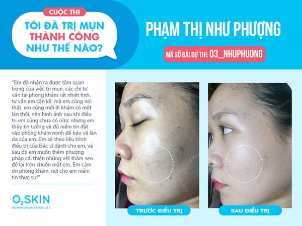 Sau khi điều trị tại O2 SKIN