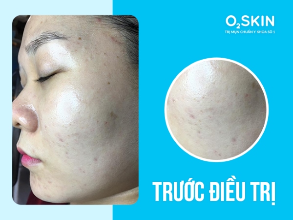 TÌnh trạng da trước khi điều trị tại O2 SKIN