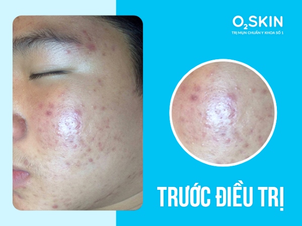 Tình trạng da trước khi điều trị tại O2 SKIN