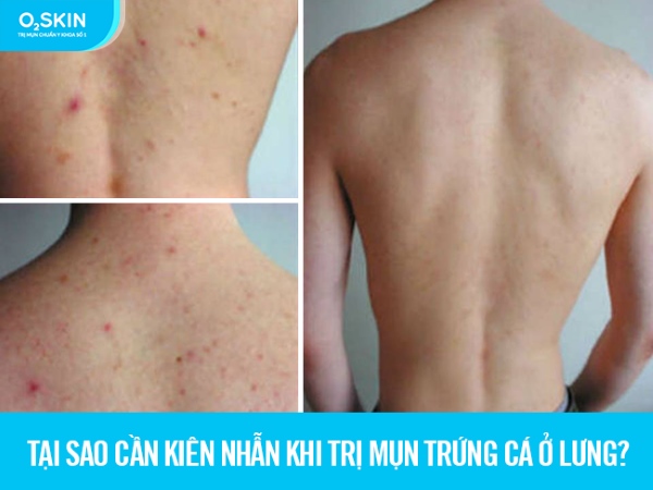 Nếu không kiên nhẫn chăm sóc và điều trị đúng cách thì mụn lưng sẽ lâu khỏi và để lại hậu quả xấu cho làn da. 