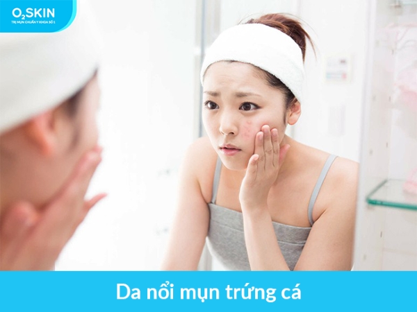 Da nổi mụn trứng cá.