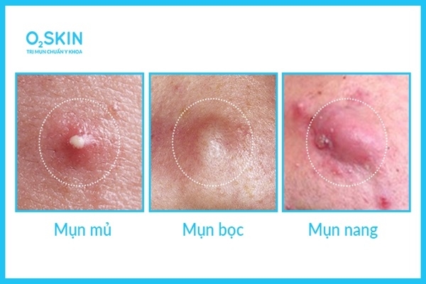 Vị trí nổi mụn mủ