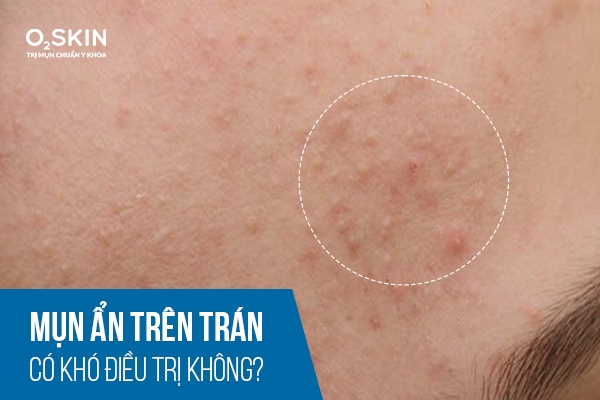 mụn ẩn trên trán là gì