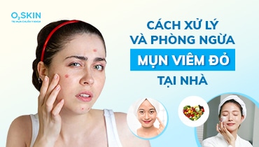 Top 5 cách trị mụn viêm đỏ ở má tại nhà hiệu quả