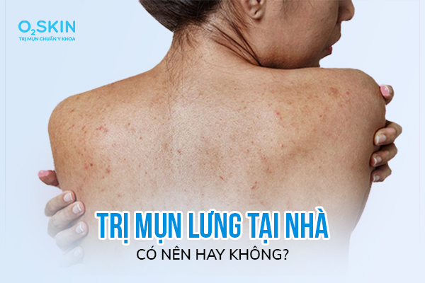 Trị mụn lưng tại nhà có nên hay không?