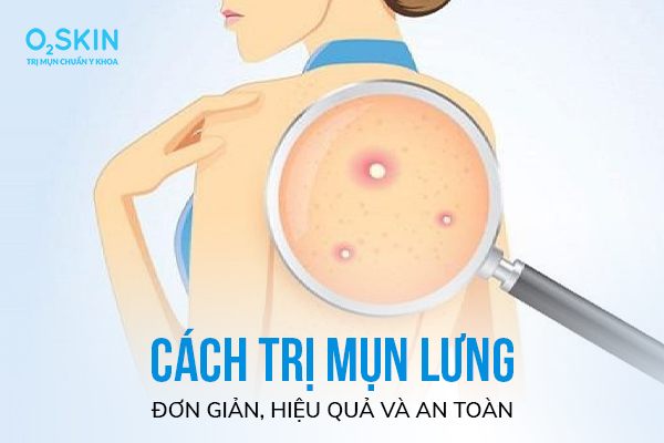 Cách Trị Mụn Lưng Đơn Giản, Hiệu Quả Và An Toàn