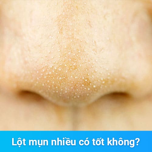 Gel lột mụn có tốt không? Bí quyết làm đẹp an toàn và hiệu quả