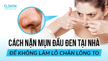 Cách nặn mụn đầu đen tại nhà để không làm lỗ chân lông to