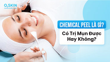 Chemical Peel Là Gì – Có Trị Mụn Được Hay Không?