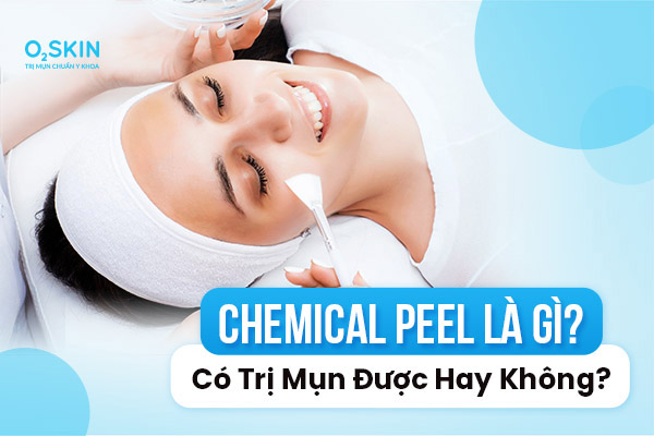 Chemical Peel có trị mụn được không?