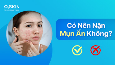 Có Nên Nặn Mụn Ẩn Không?