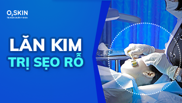 Lăn kim trị sẹo rỗ