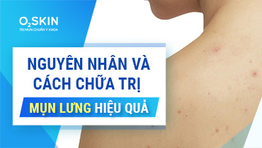 Mụn Lưng - Nguyên Nhân Và Cách Chữa Trị Hiệu Quả