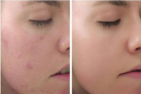 Ưu điểm - Nhược điểm của Chemical Peel