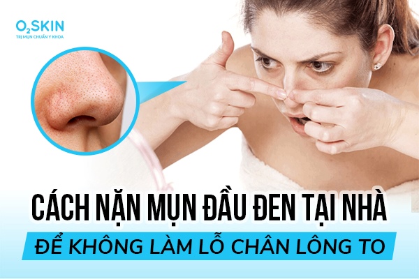 Cách nặn mụn đầu đen tại nhà