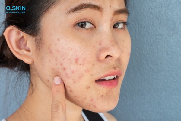 các bước skincare cho tuổi dậy thì