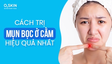 Mụn bọc ở cằm: Nguyên nhân, cách điều trị và các lưu ý cần biết