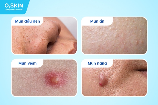 Các dạng mụn trứng cá dậy thì