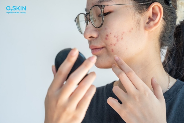 Mụn tuổi dậy thì trị được không