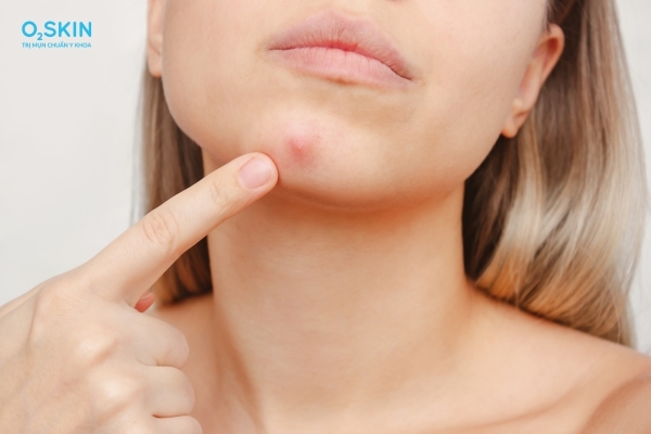 Nguyên nhân nổi mụn bọc ở cằm