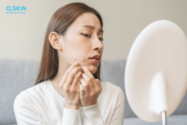 Mụn trứng cá ở tuổi dậy thì do nội tiết