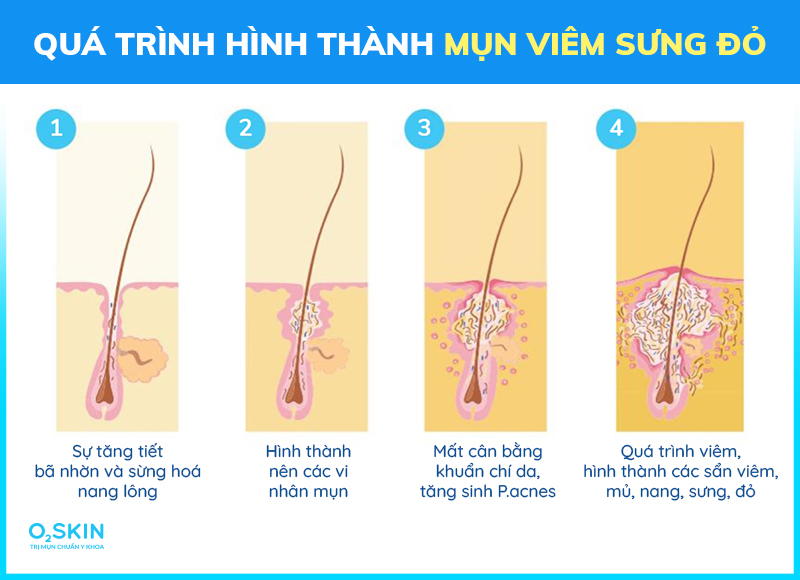 mụn sưng viêm