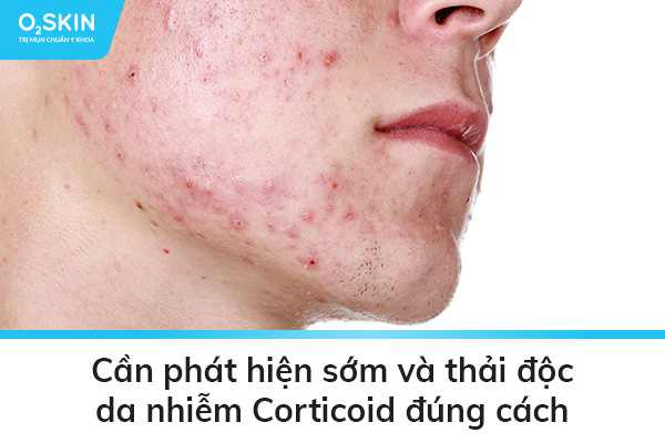 Cần phát hiện sớm và thải độc da nhiễm Corticoid đúng cách