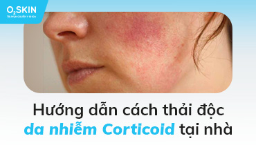 Cách thải độc da nhiễm corticoid tại nhà